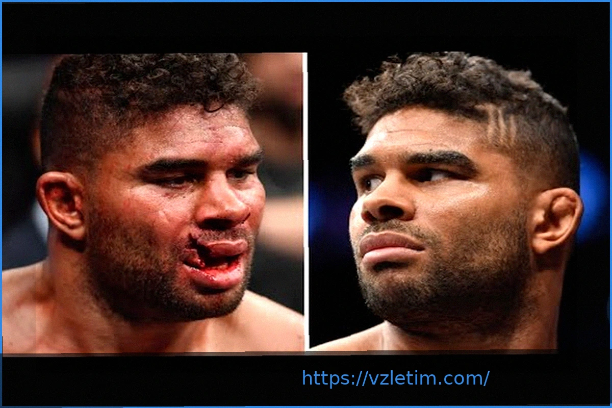 Preview Звезда UFC показала шокирующее видео: из ее глаза извлекли трубку после ужасной травмы